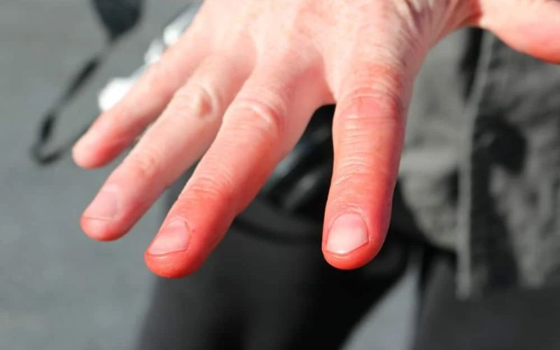 Tiếp xúc trực tiếp với đá khô có thể gây bỏng lạnh và tổn thương da.